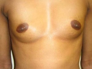 Manhattan Breast Augmentation Before 1